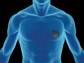 Diabetics end up needing pacemakers fairly often, so they’re 